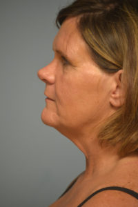 Neck Lift Before and After Pictures in Philadelphia, PA