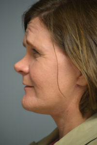 Neck Lift Before and After Pictures in Philadelphia, PA
