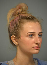 Rhinoplasty Before and After Pictures in Philadelphia, PA