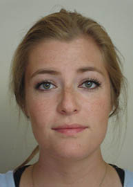 Rhinoplasty Before and After Pictures in Philadelphia, PA