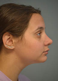 Rhinoplasty Before and After Pictures in Philadelphia, PA