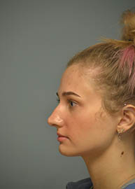 Rhinoplasty Before and After Pictures in Philadelphia, PA