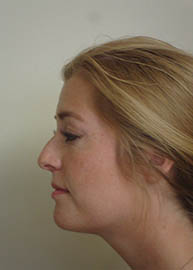 Rhinoplasty Before and After Pictures in Philadelphia, PA