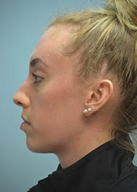 Rhinoplasty Before and After Pictures in Philadelphia, PA