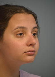 Rhinoplasty Before and After Pictures in Philadelphia, PA