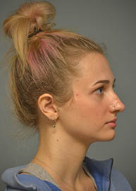 Rhinoplasty Before and After Pictures in Philadelphia, PA