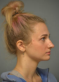 Rhinoplasty Before and After Pictures in Philadelphia, PA