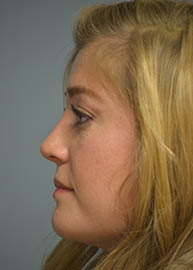 Rhinoplasty Before and After Pictures in Philadelphia, PA