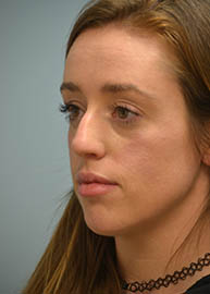 Rhinoplasty Before and After Pictures in Philadelphia, PA