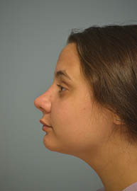 Rhinoplasty Before and After Pictures in Philadelphia, PA