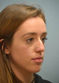 Rhinoplasty Before and After Pictures in Philadelphia, PA