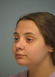 Rhinoplasty Before and After Pictures in Philadelphia, PA