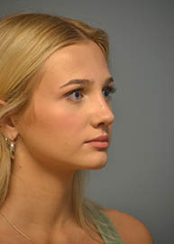 Rhinoplasty Before and After Pictures in Philadelphia, PA