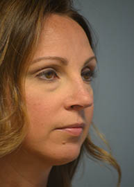 Rhinoplasty Before and After Pictures in Philadelphia, PA