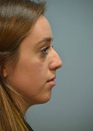 Rhinoplasty Before and After Pictures in Philadelphia, PA