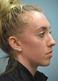 Rhinoplasty Before and After Pictures in Philadelphia, PA