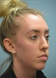 Rhinoplasty Before and After Pictures in Philadelphia, PA