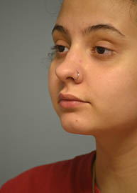 Rhinoplasty Before and After Pictures in Philadelphia, PA