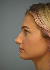 Rhinoplasty Before and After Pictures in Philadelphia, PA