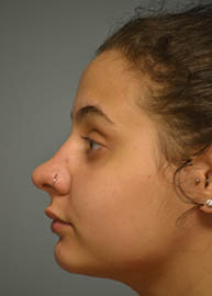 Rhinoplasty Before and After Pictures in Philadelphia, PA