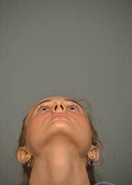 Rhinoplasty Before and After Pictures in Philadelphia, PA