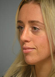 Rhinoplasty Before and After Pictures in Philadelphia, PA