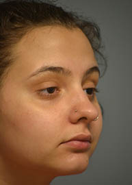 Rhinoplasty Before and After Pictures in Philadelphia, PA