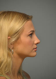 Rhinoplasty Before and After Pictures in Philadelphia, PA