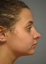 Rhinoplasty Before and After Pictures in Philadelphia, PA