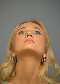 Rhinoplasty Before and After Pictures in Philadelphia, PA