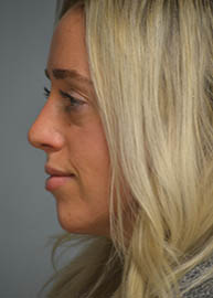 Rhinoplasty Before and After Pictures in Philadelphia, PA