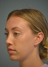 Rhinoplasty Before and After Pictures in Philadelphia, PA