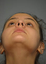 Rhinoplasty Before and After Pictures in Philadelphia, PA