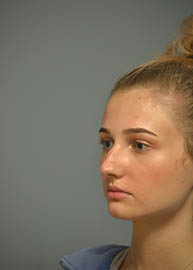 Rhinoplasty Before and After Pictures in Philadelphia, PA