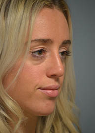 Rhinoplasty Before and After Pictures in Philadelphia, PA