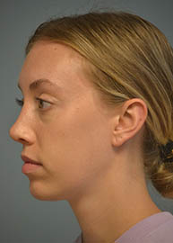 Rhinoplasty Before and After Pictures in Philadelphia, PA