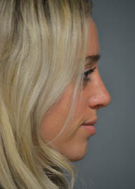 Rhinoplasty Before and After Pictures in Philadelphia, PA