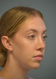 Rhinoplasty Before and After Pictures in Philadelphia, PA