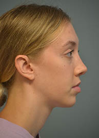 Rhinoplasty Before and After Pictures in Philadelphia, PA