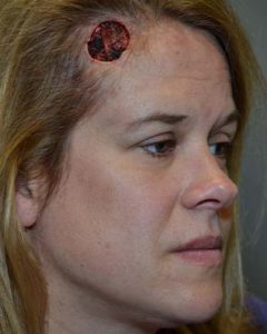 Skin Cancer Reconstruction Brow Lift Before and After Pictures Philadelphia, PA