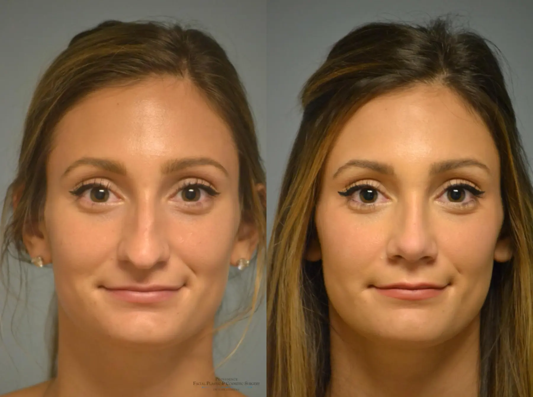 Rhinoplasty Before and After