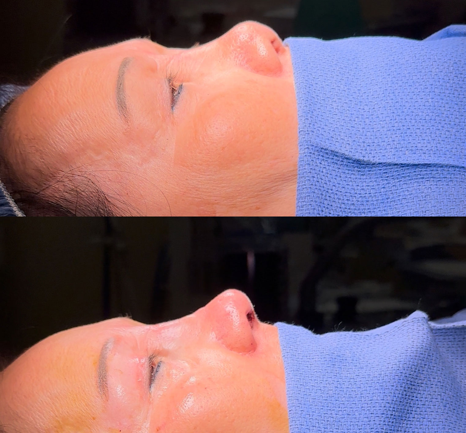 Woman who received a revision rhinoplasty in Philadelphia, PA.