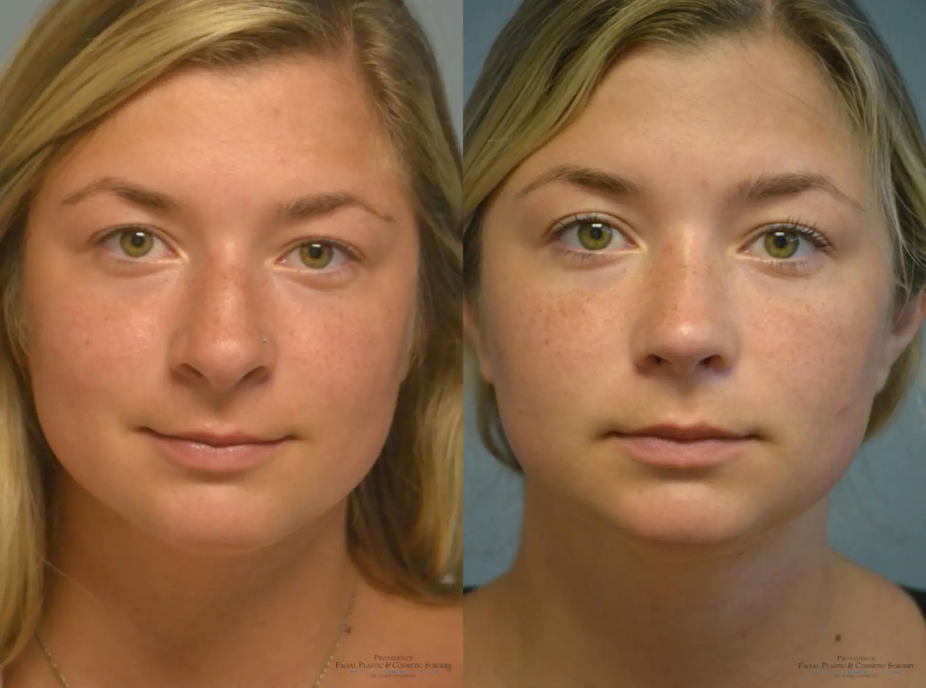 rhinoplasty-before-and-after-2-feat Man after receiving rhinoplasty in Philadelphia at Providence Cosmetic Surgery
