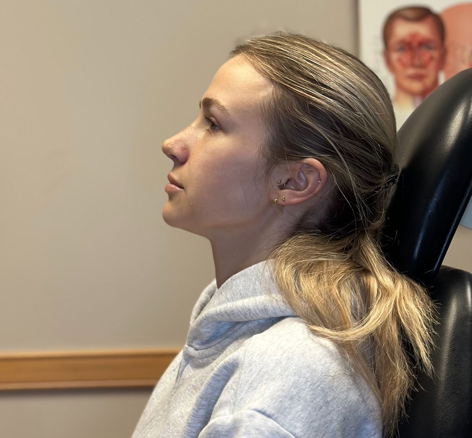 Beautiful woman who received a septoplasty in Philadelphia.