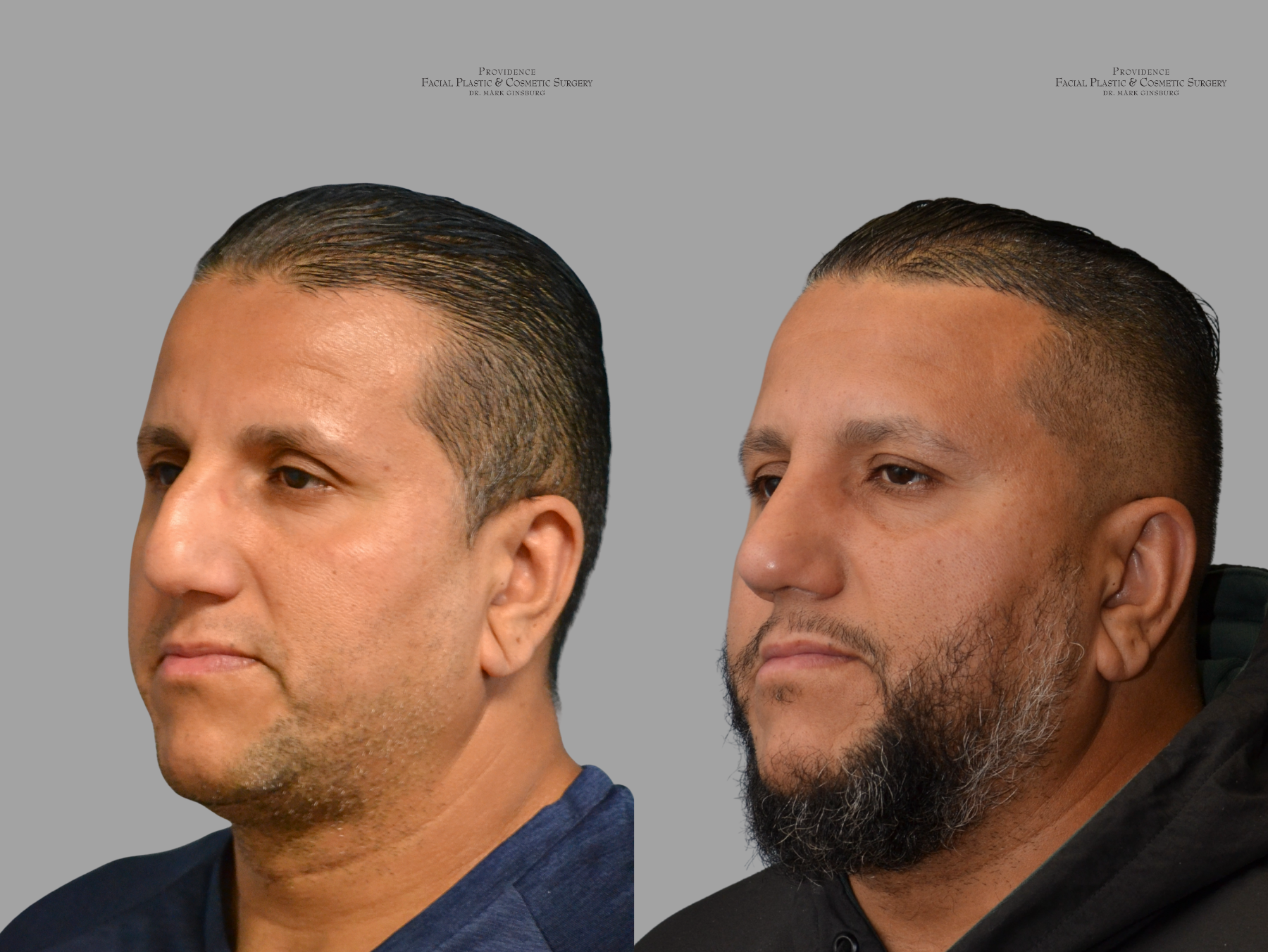 Functional rhinoplasty patient from Providence Cosmetic Surgery in Philadelphia, PA 