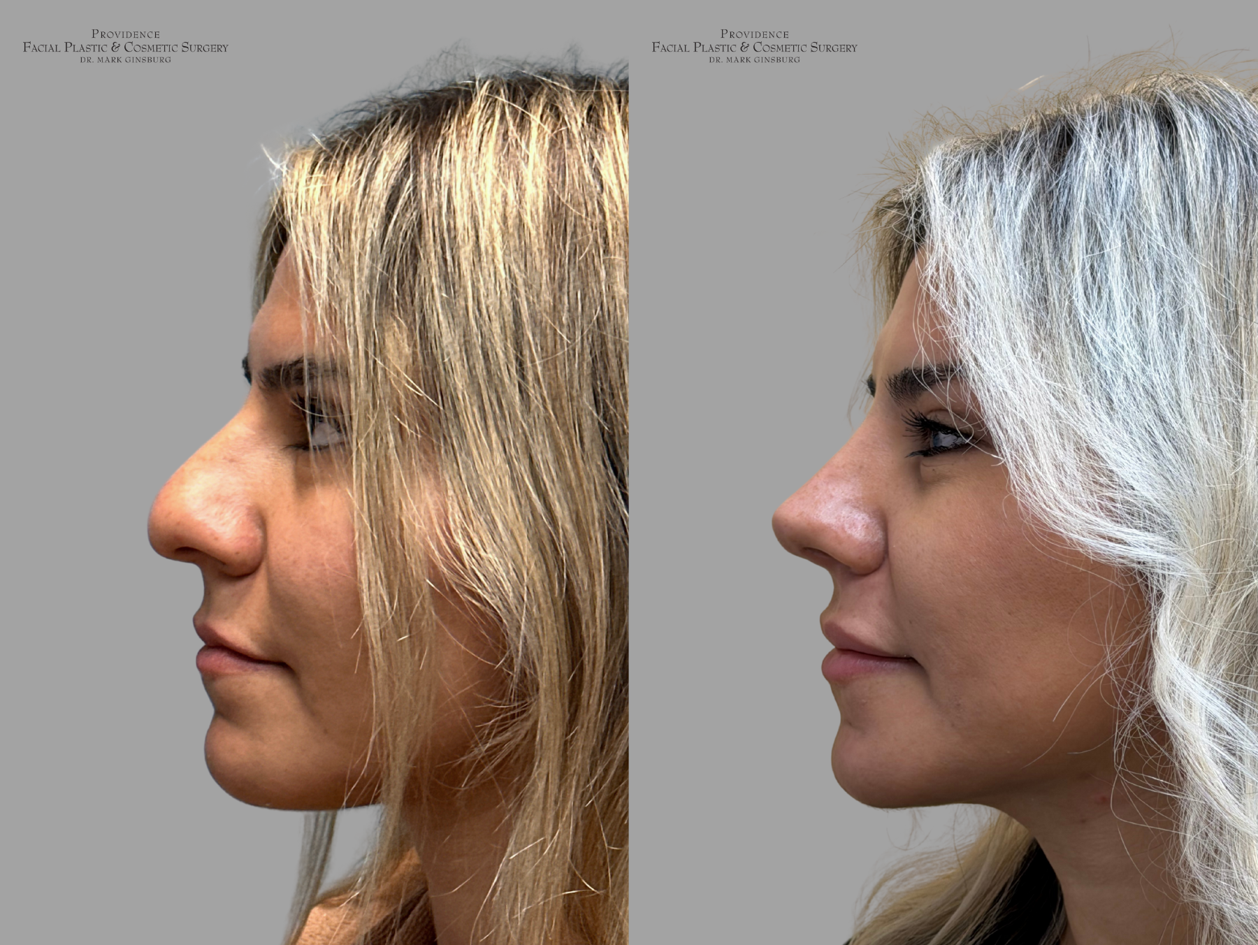 Patient after a facelift in Philadelphia with Providence Cosmetic Surgery