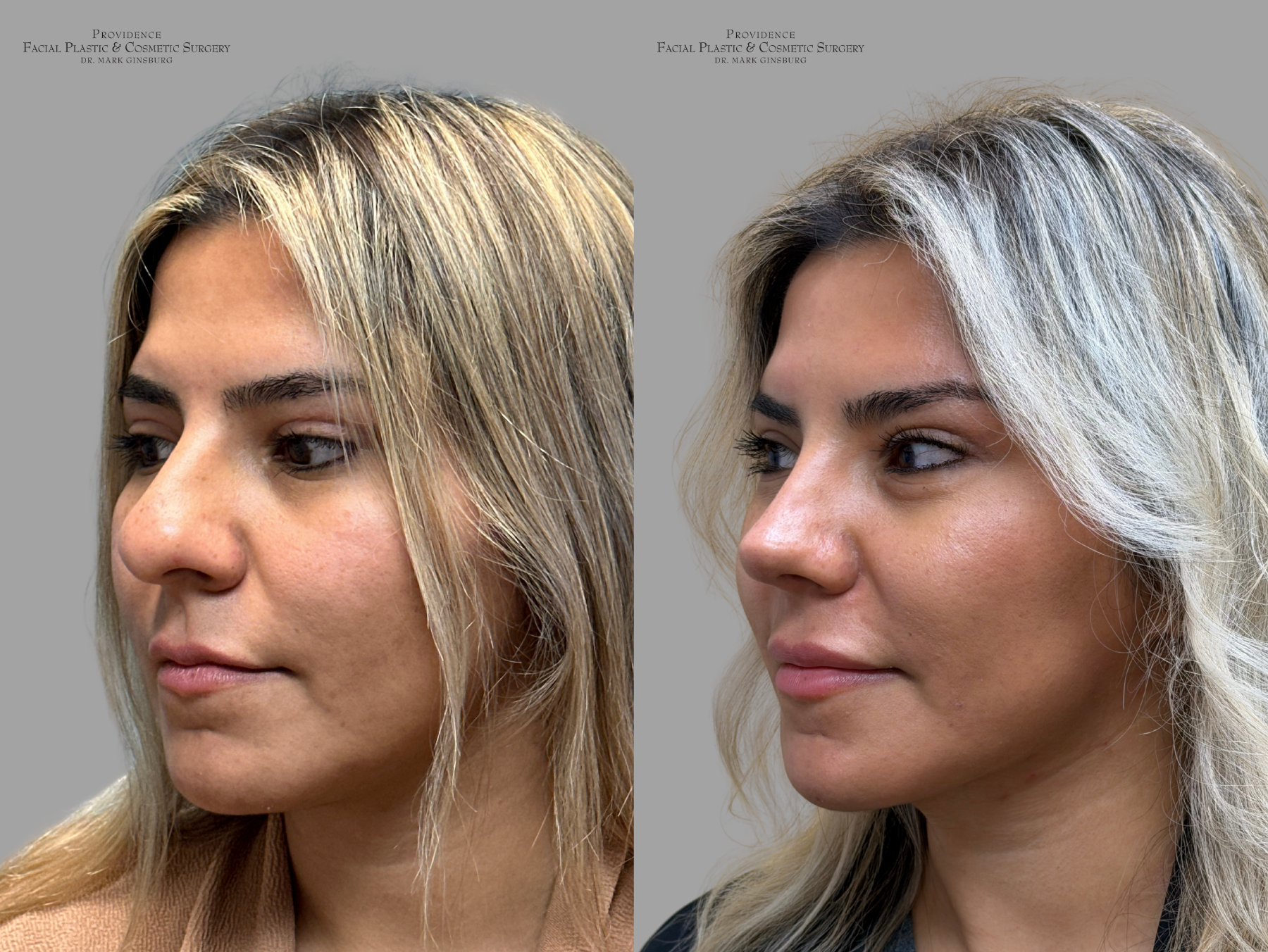 Philadelphia woman after receiving a facelift in Philadelphia, PA