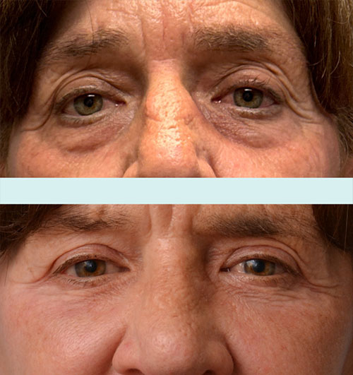 Patient after a facelift in Philadelphia with Providence Cosmetic Surgery