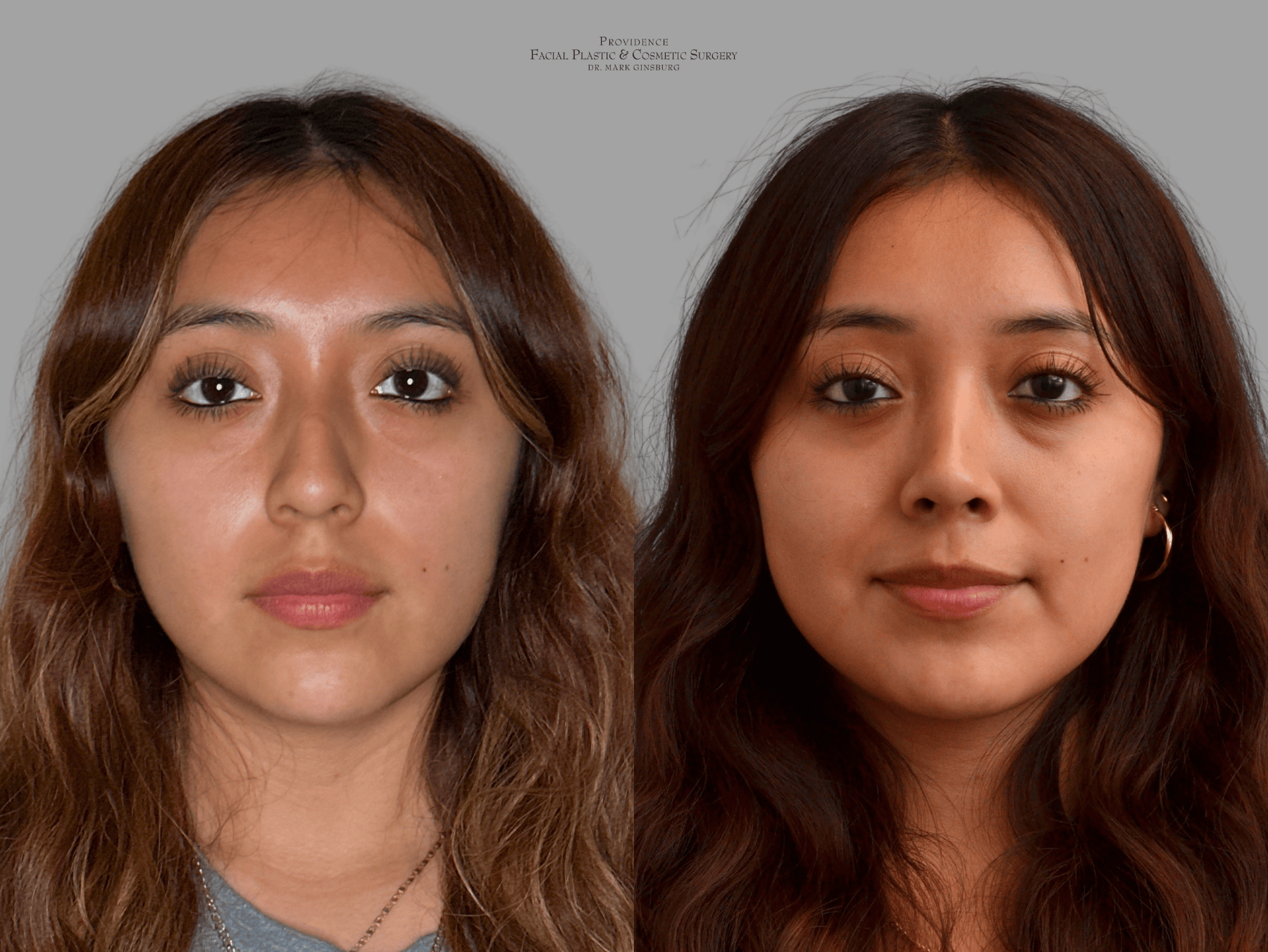 Philadelphia woman after receiving a facelift in Philadelphia, PA