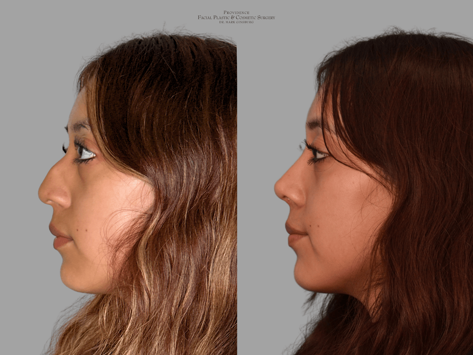 Patient after a facelift in Philadelphia with Providence Cosmetic Surgery